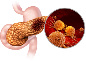 Pancreatic Cancer: Early Detection and Treatment Options | Dr. Harshal Rajekar